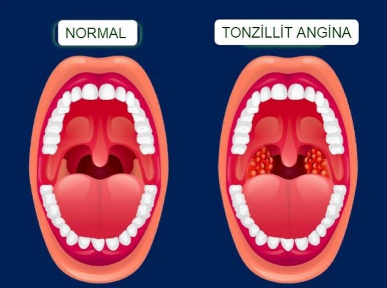 Angina: Səbəbləri, Müalicə Yolları