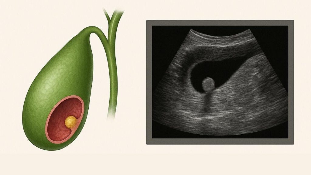 Öddə Polip: Diaqnostika, Risklər, Müalicə Yanaşmaları