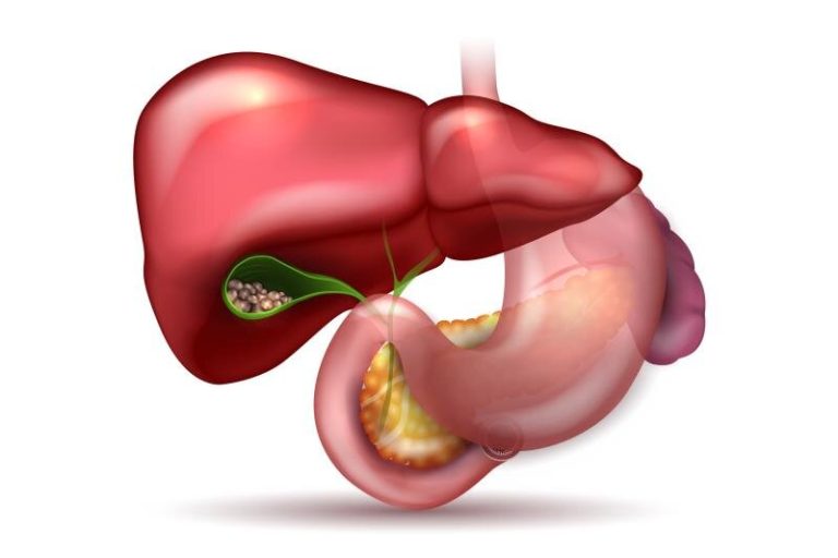 Öd Xərçəngi : Yaranma Səbəbləri,Klinik Gedişi, Müalicə Üsulları