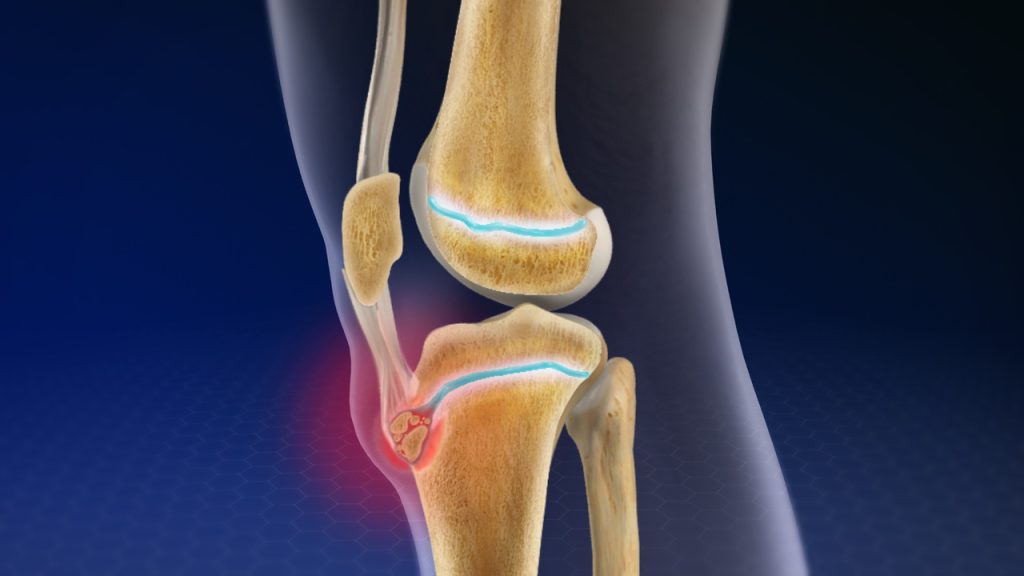 Osgood Schlatter Xəstəliyi: Tibbi Tərifi, Əlamətləri