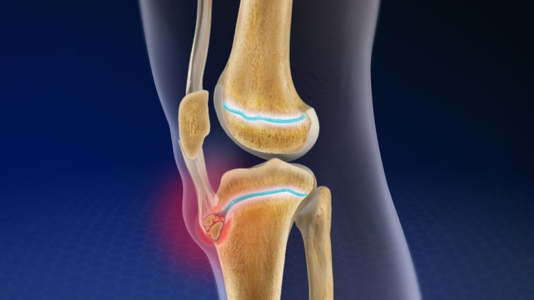 Osgood Schlatter Xəstəliyi: Tibbi Tərifi, Əlamətləri