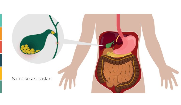Öd Daşı: Əlamətləri, Tibbi Müalicəsi