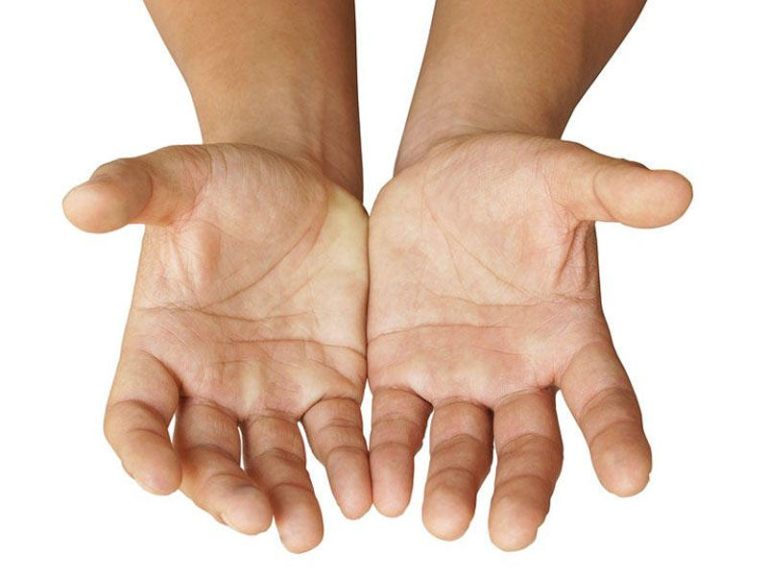 Əllərin Saralması : Klinik Təsviri, Sarılıq