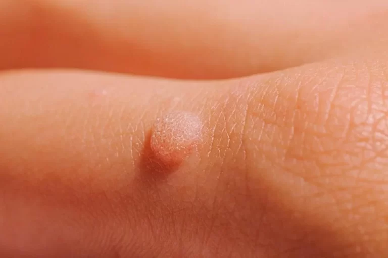 Əllərdə Ziyil : HPV Rolu, Ziyilin Növləri