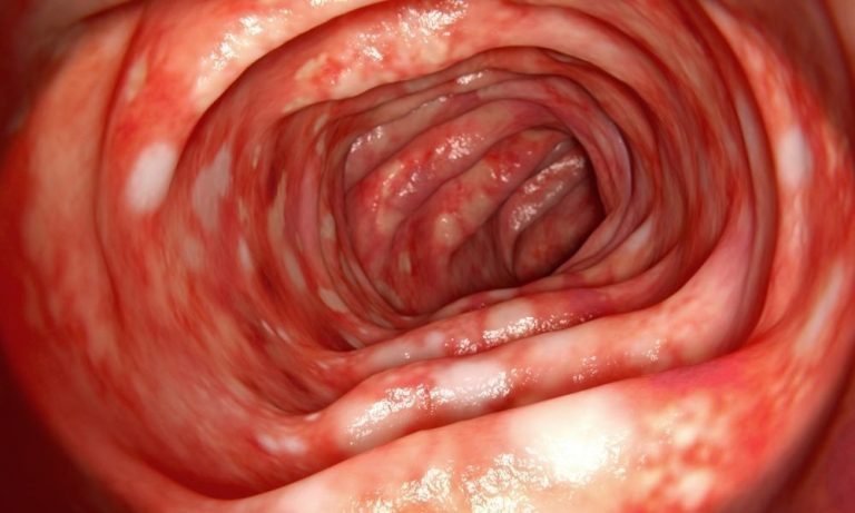 Xoralı Kolit:Diaqnoz, Müalicə Üsulları