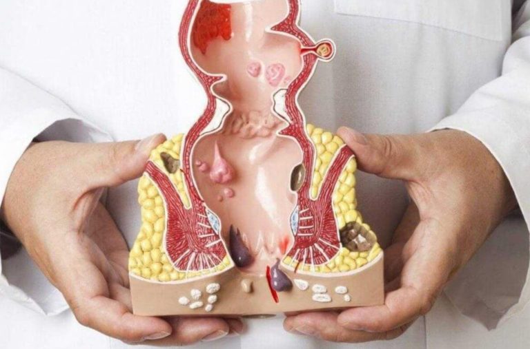 Babasil: Müalicəsi, Növləri, Klinik Mərhələləri