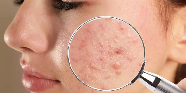 Çivzə : Nədir? Klinik Əlamətləri, Diaqnostikası