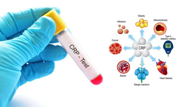 CRP Analizi Nədir? Ölçülməsi, Xəstəliklərdə rolu