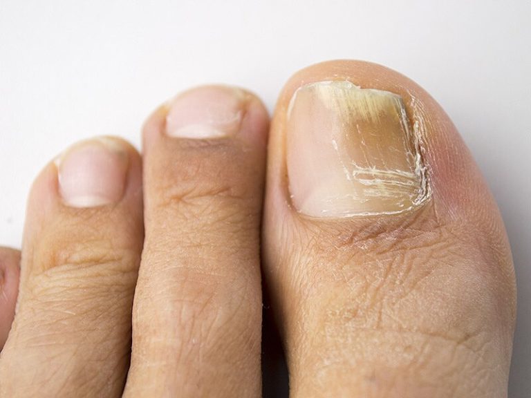 Dırnaq Göbələyi : Səbəbləri, Yoluxma Yolları, Klinik Əlamətləri