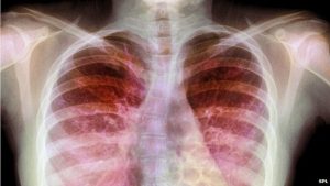 Fibroz : Risk Faktorları, Növləri,Lokalzasiyaları