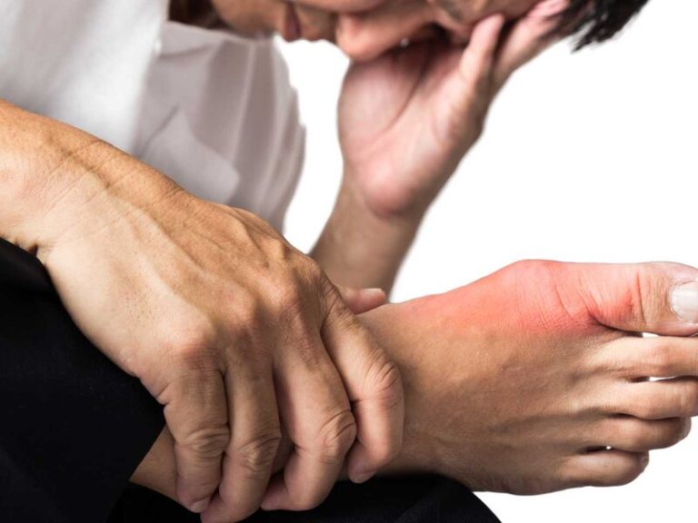 Gut Xəstəliyi: Uzunmüddətli Profilaktika, Risk Faktorları