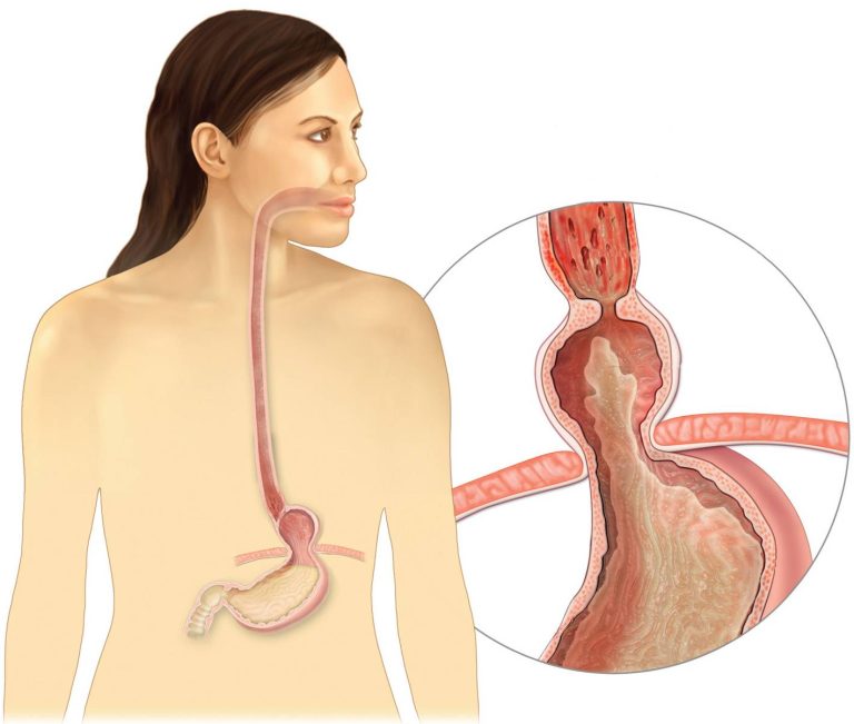 Hiatal Yırtıq : Patogenez, Faktorlar